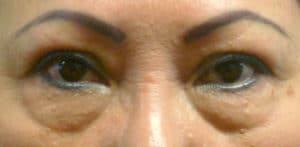 Lower Lid Blepharoplasty - Before